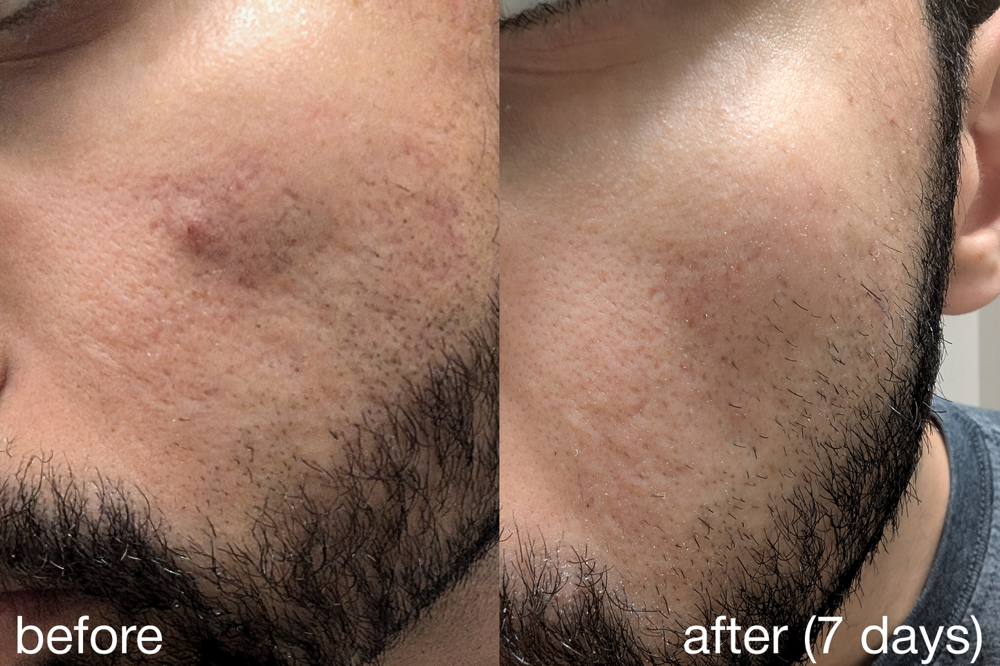 novoLUX™ nano . acne duo