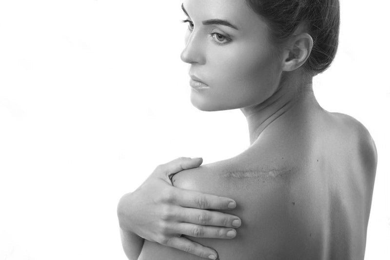 Black and white image of a woman with a visible scar on her shoulder.