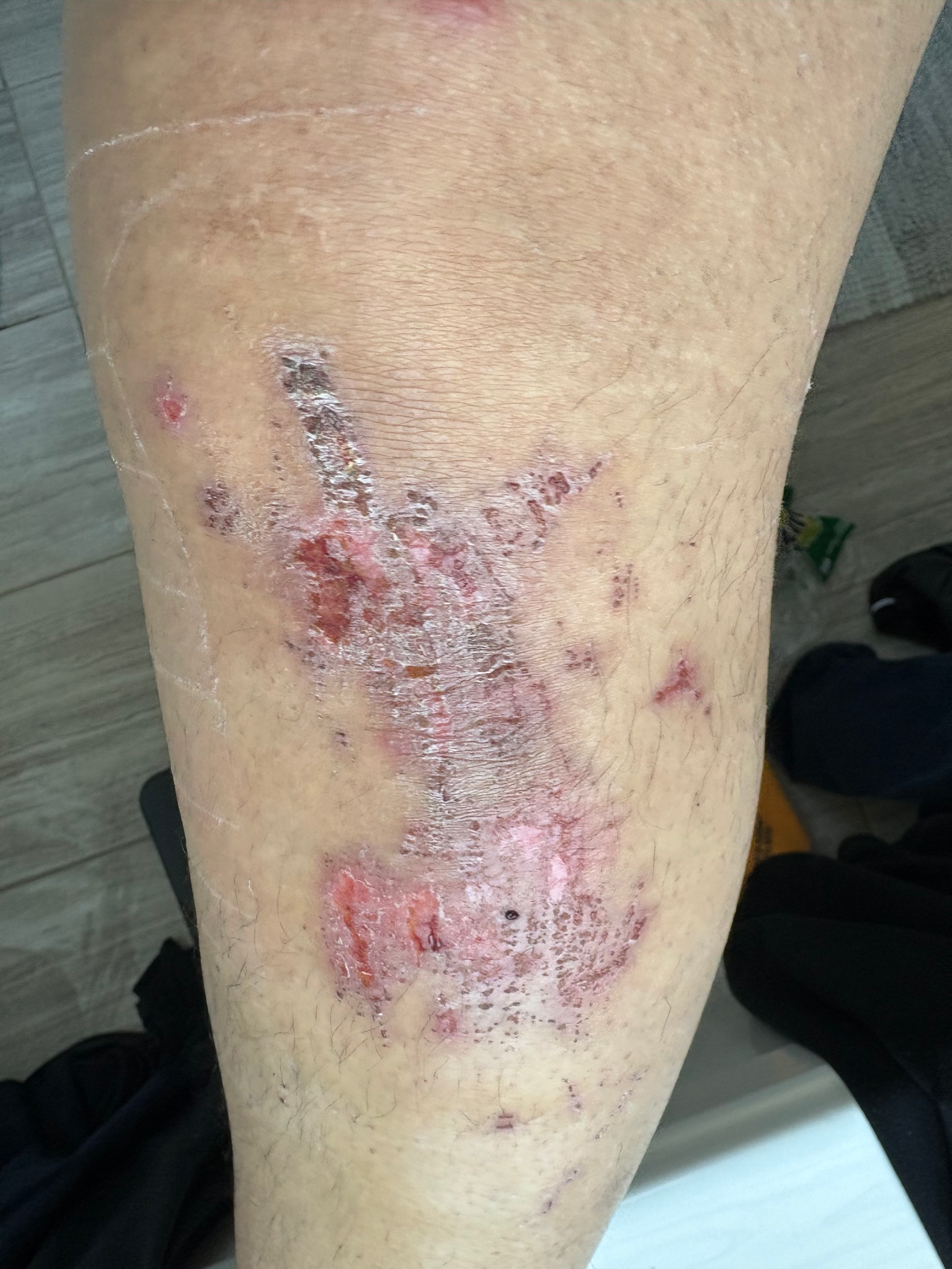 Scarred and irritated skin on a person's leg with a transparent bandage.