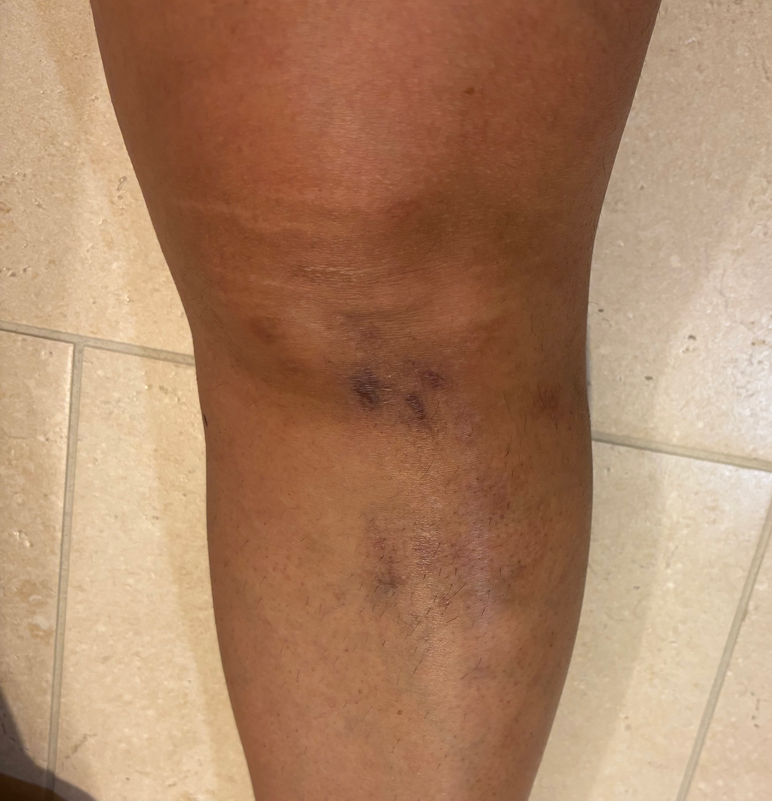 Leg with visible varicose veins on a tiled floor