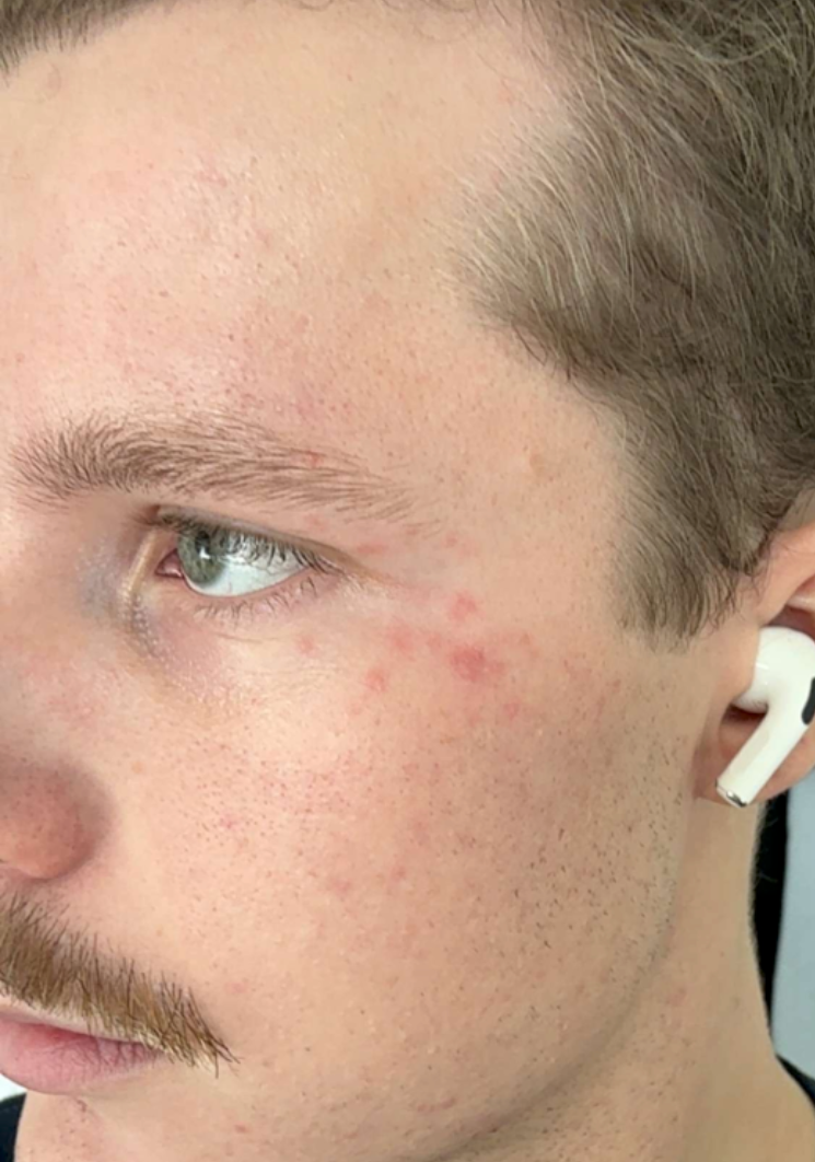 Close-up of a person's face with visible skin imperfections