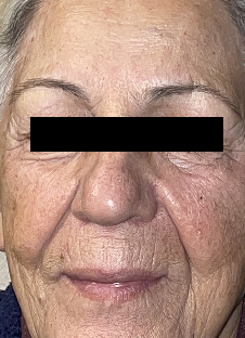 Close-up of an elderly person's face showing visible wrinkles with a blurred area over the eyes.