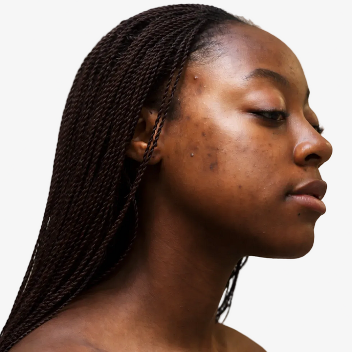 acne & texture