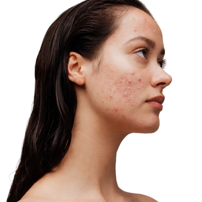 acne-prone skin & texture
