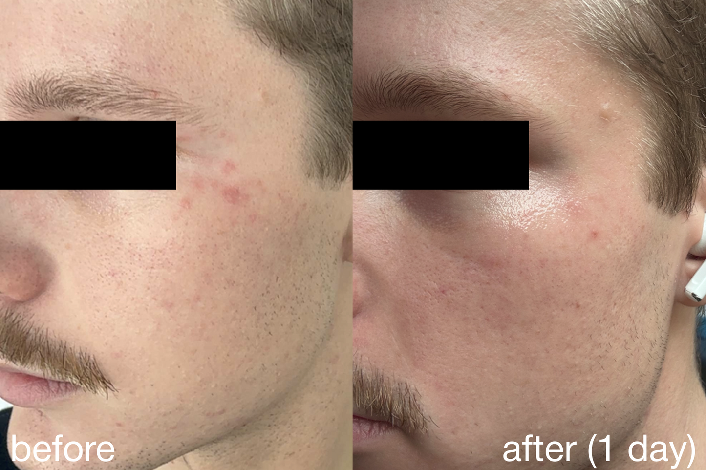 novoLUX™ nano . acne duo