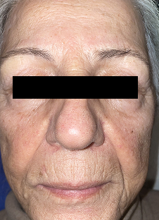 Close-up of an elderly person's face with brighter, more hydrated skin after using CNANO's novoLUX nano peptide glow for 14 days.