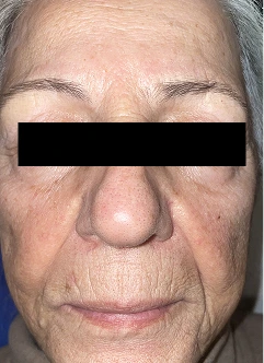 Results of using novoLUX peptide glow for two weeks