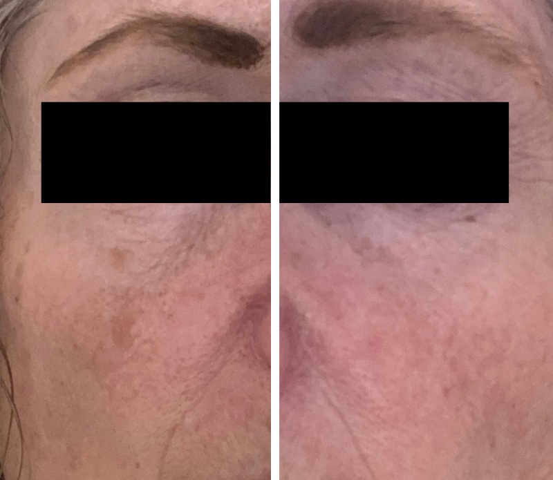 Before and after comparison of undereye area with black boxes over eyes