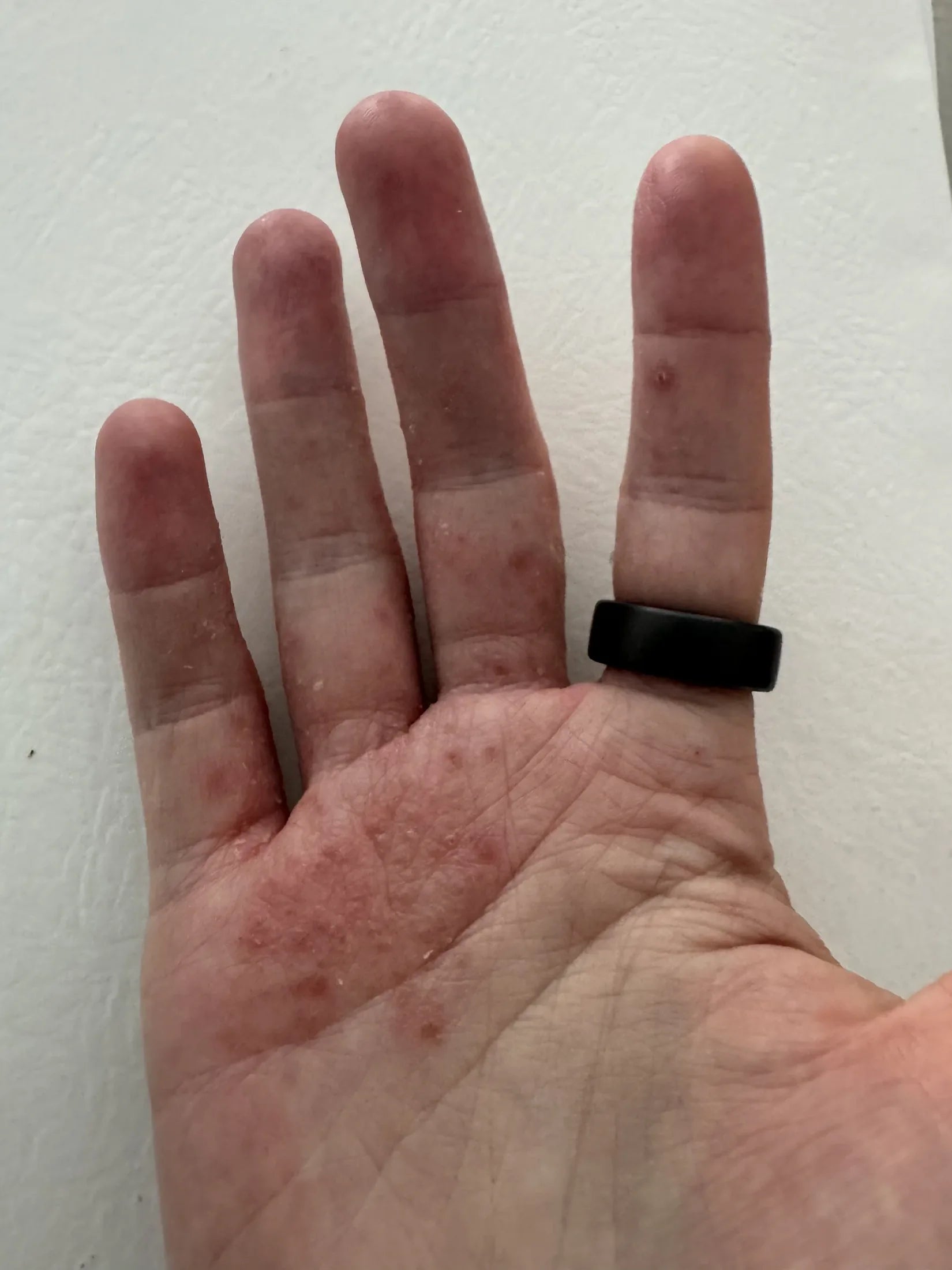 Hand with eczema 
