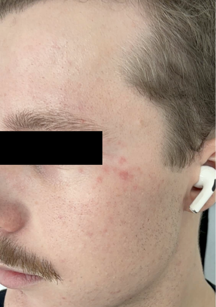 Close-up of a person's face with visible acne on the cheek.