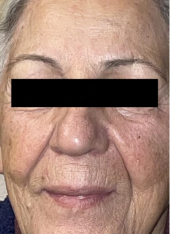 Before using CNANO's novoLUX peptide glow
