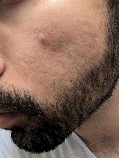 Man with visible acne on his cheek