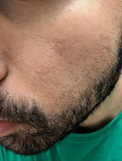 Close-up of man's cheek showing clear skin after using novoLUX acne duo for 7 days.