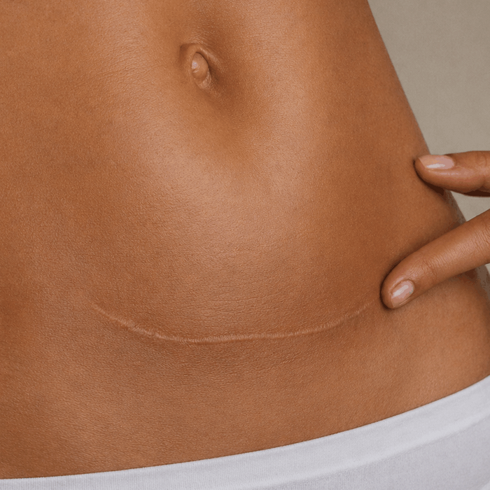 post-procedure repair